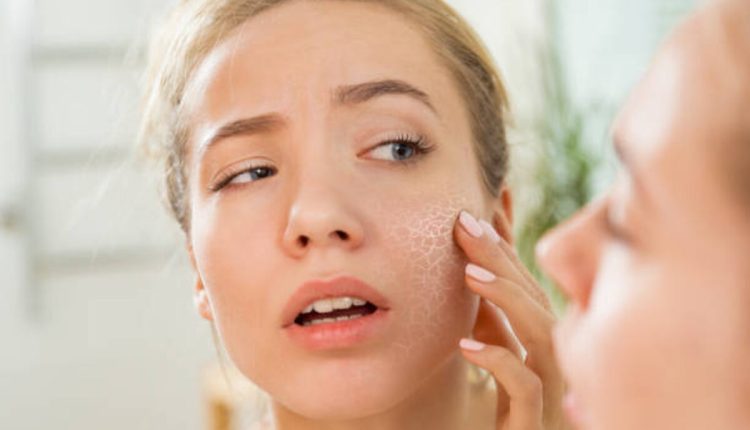 Dry Skin